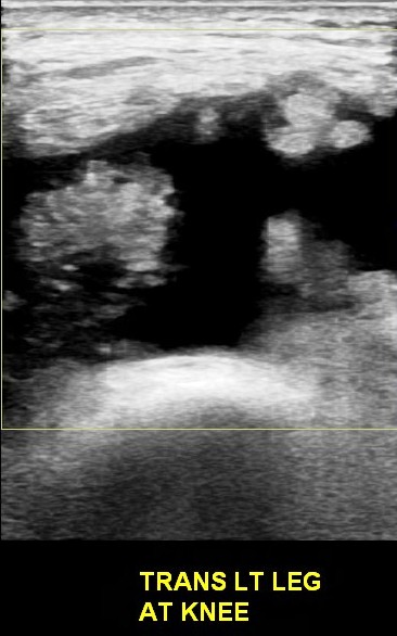 Figure 2 for case Lipoma arborescens